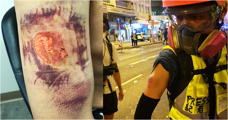 Student journalist reportedly shot with tear gas round and sustains third-degree burn