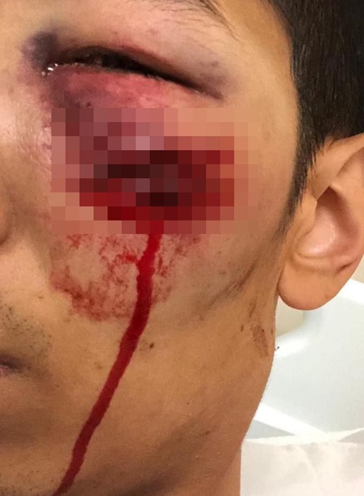 Aimed and fired rubber bullet directly at a protester’s head (3) Permanently blinding a male teacher