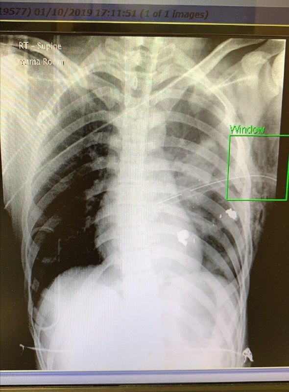 2019.10.01 警察近距離實彈射擊中五學生 險中心臟